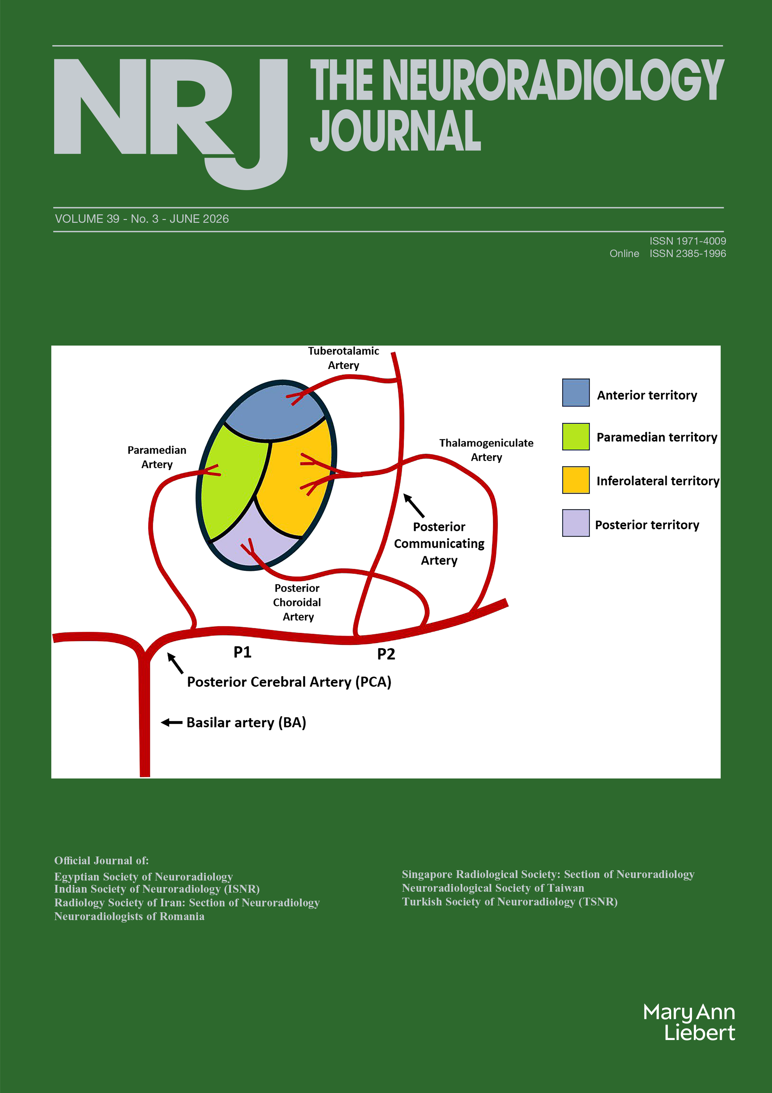 Unique cause of right hemispheric syndrome: Embolism of myocardium ...